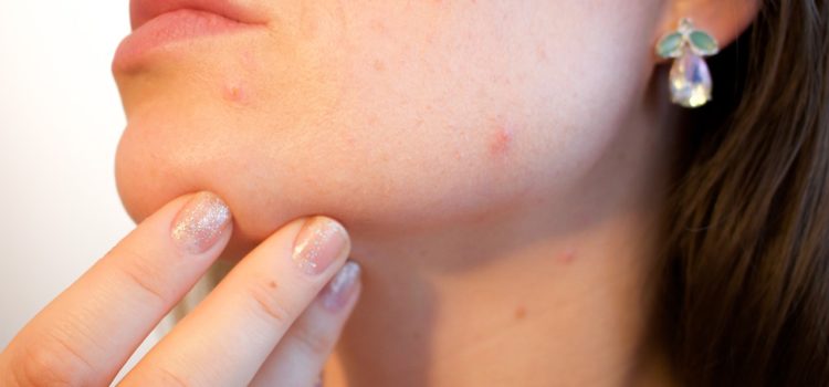 How To Reduce Pimples Naturally And Have A Beautiful Healthy Skin