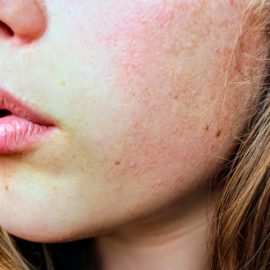 Whiteheads On Chin Removal – How To Get Rid Of Them Efficiently